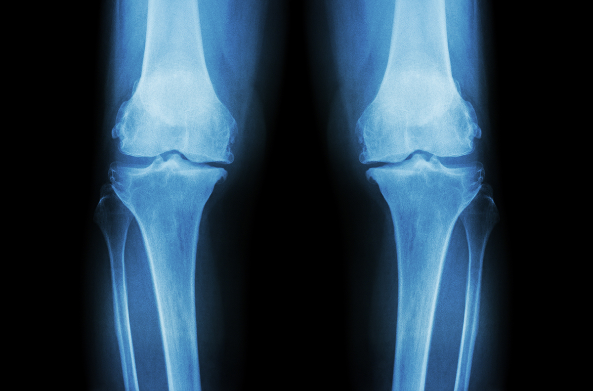 Picture of Knee Cartilage X-Ray